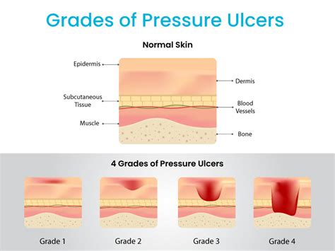 sore uei|Pressure ulcers: revised definition and measurement